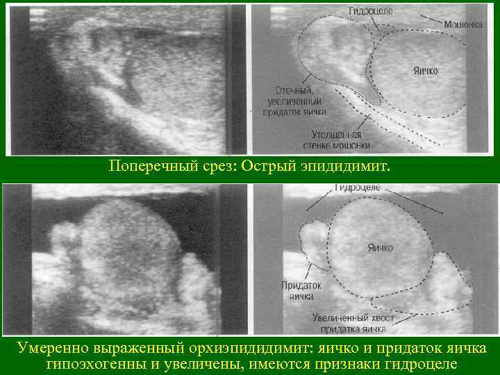 Поперечный срез: Острый эпидидимит. Умеренно выраженный орхиэпидидимит: яичко и придаток яичка гипоэхогенны и увеличены,