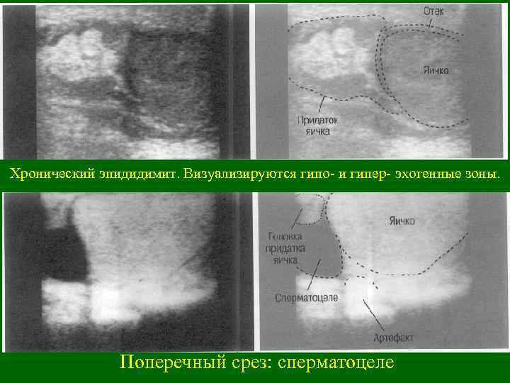 Хронический эпидидимит. Визуализируются гипо- и гипер- эхогенные зоны. Поперечный срез: сперматоцеле 