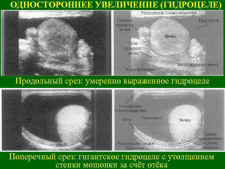 ОДНОСТОРОННЕЕ УВЕЛИЧЕНИЕ (ГИДРОЦЕЛЕ) Продольный срез: умеренно выраженное гидроцеле Поперечный срез: гигантское гидроцеле с утолщением