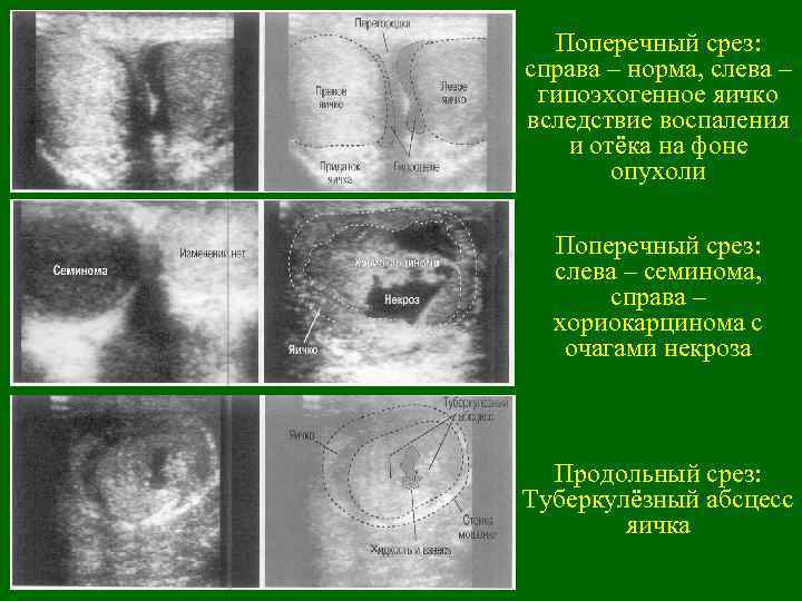 Поперечный срез: справа – норма, слева – гипоэхогенное яичко вследствие воспаления и отёка на