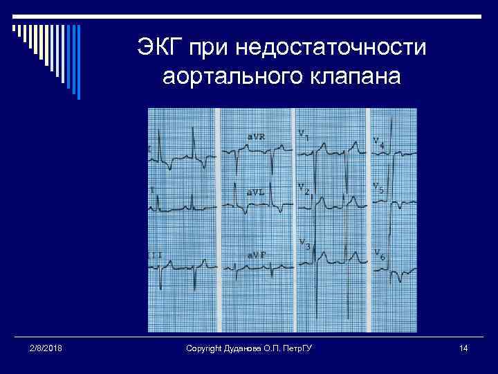 ЭКГ при недостаточности аортального клапана 2/8/2018 Copyright Дуданова О. П. Петр. ГУ 14 