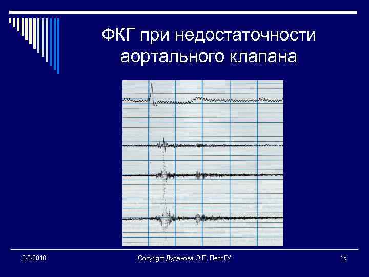 ФКГ при недостаточности аортального клапана 2/8/2018 Copyright Дуданова О. П. Петр. ГУ 15 