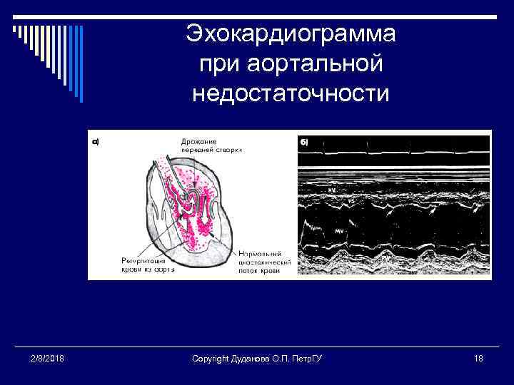 Эхокардиограмма при аортальной недостаточности 2/8/2018 Copyright Дуданова О. П. Петр. ГУ 18 