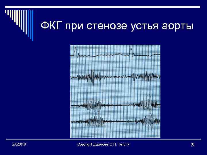 ФКГ при стенозе устья аорты 2/8/2018 Copyright Дуданова О. П. Петр. ГУ 30 