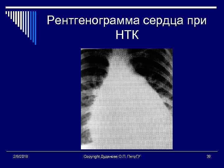 Рентгенограмма сердца при НТК 2/8/2018 Copyright Дуданова О. П. Петр. ГУ 39 