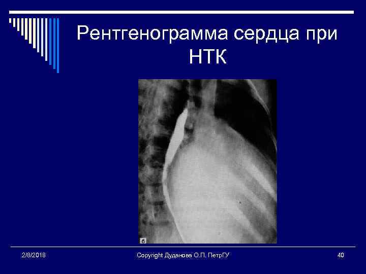 Рентгенограмма сердца при НТК 2/8/2018 Copyright Дуданова О. П. Петр. ГУ 40 