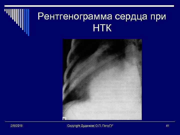 Рентгенограмма сердца при НТК 2/8/2018 Copyright Дуданова О. П. Петр. ГУ 41 