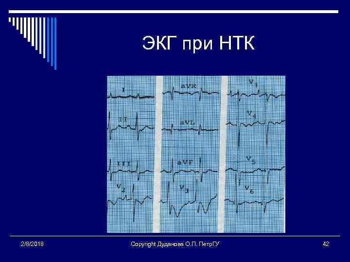 ЭКГ при НТК 2/8/2018 Copyright Дуданова О. П. Петр. ГУ 42 
