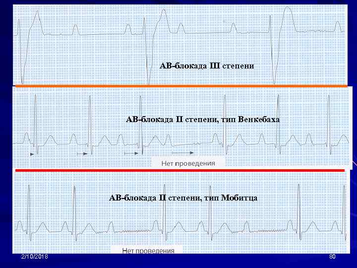 АВ-блокада III степени АВ-блокада II степени, тип Венкебаха АВ-блокада II степени, тип Мобитца 2/10/2018