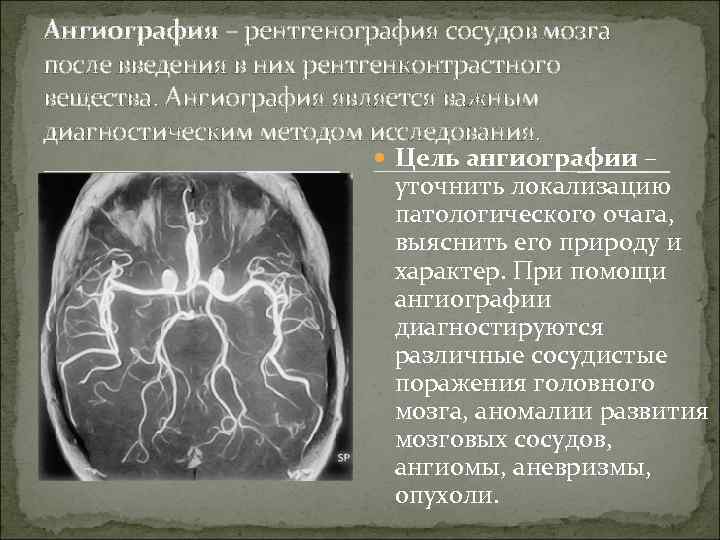 Ангиография сосудов головного