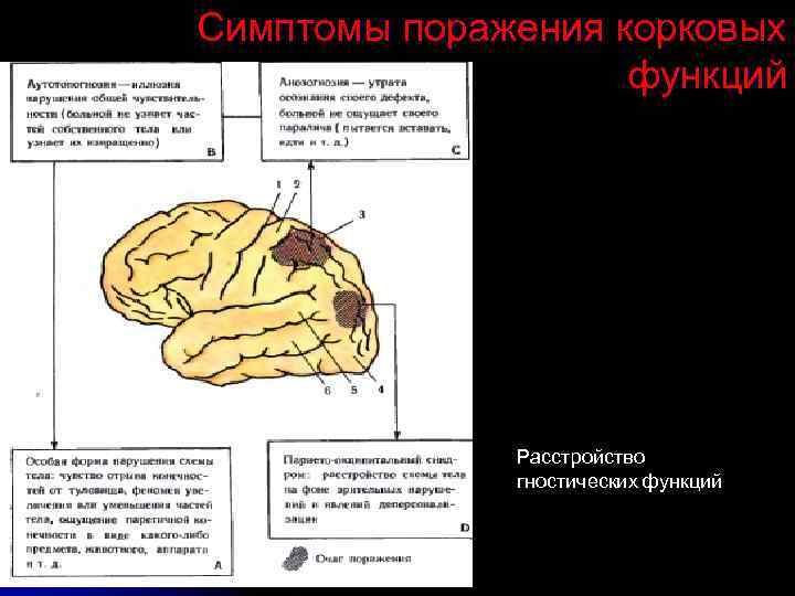 Симптомы поражения корковых функций Расстройство гностических функций 