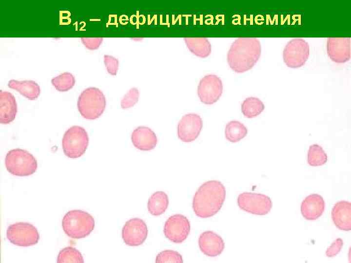 B 12 – дефицитная анемия 