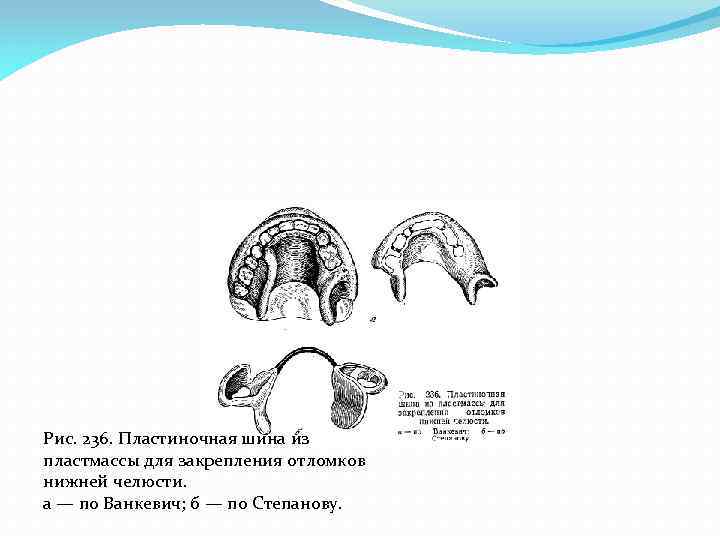 Рис. 236. Пластиночная шина из пластмассы для закрепления отломков нижней челюсти. а — по