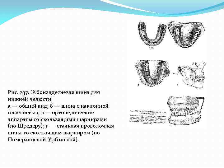 Механизмы перелома нижней челюсти. Шина скоба на нижнюю челюсть. Шина скоба с наклонной плоскостью. Шина Тигерштедта с наклонной плоскостью. Шина скоба с распорочным изгибом.