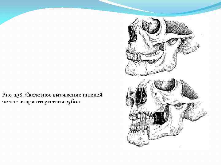 Рис. 238. Скелетное вытяжение нижней челюсти при отсутствии зубов. 