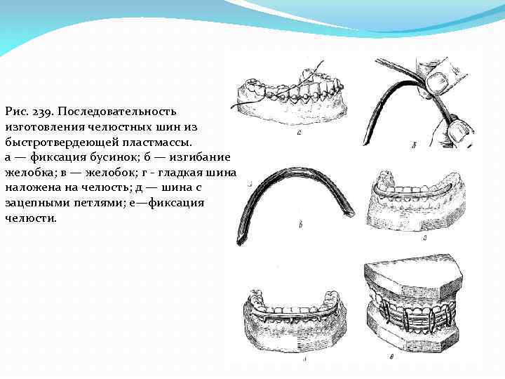 Рис. 239. Последовательность изготовления челюстных шин из быстротвердеющей пластмассы. а — фиксация бусинок; б