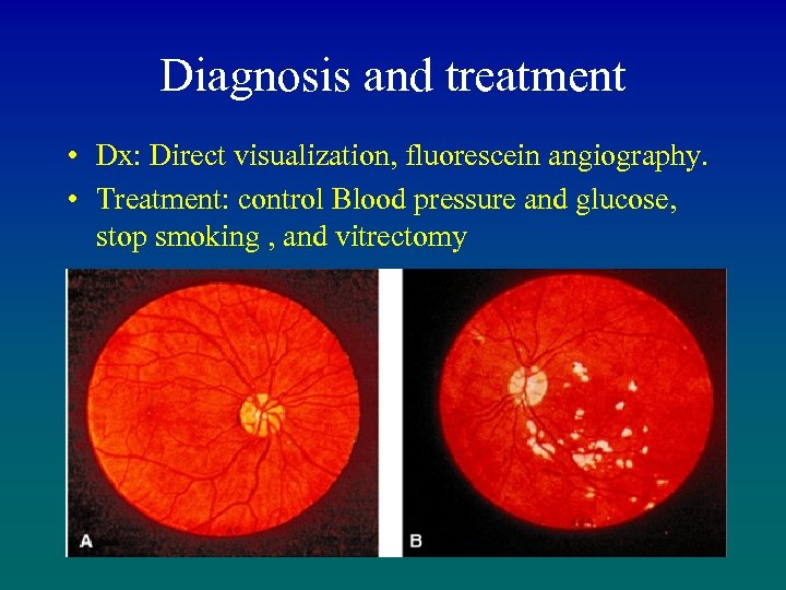 Diagnosis and treatment • Dx: Direct visualization, fluorescein angiography. • Treatment: control Blood pressure