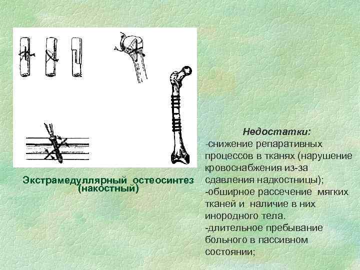 Экстрамедуллярный остеосинтез (накостный) Недостатки: -снижение репаративных процессов в тканях (нарушение кровоснабжения из-за сдавления надкостницы);