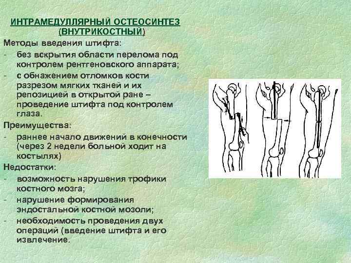 ИНТРАМЕДУЛЛЯРНЫЙ ОСТЕОСИНТЕЗ (ВНУТРИКОСТНЫЙ) Методы введения штифта: - без вскрытия области перелома под контролем рентгеновского
