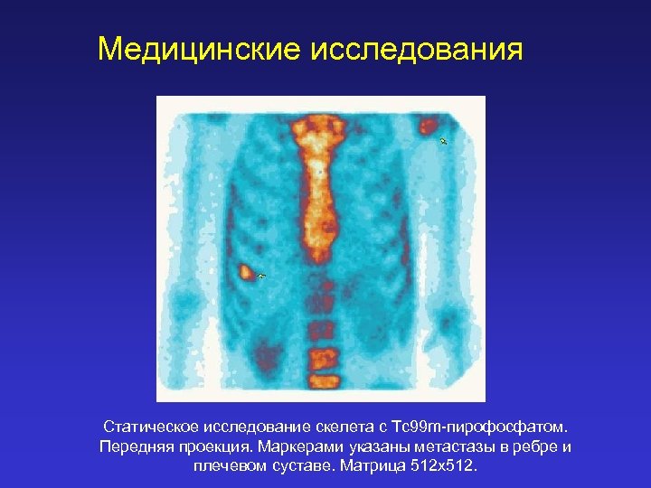 Медицинские исследования Статическое исследование скелета с Tc 99 m-пирофосфатом. Передняя проекция. Маркерами указаны метастазы