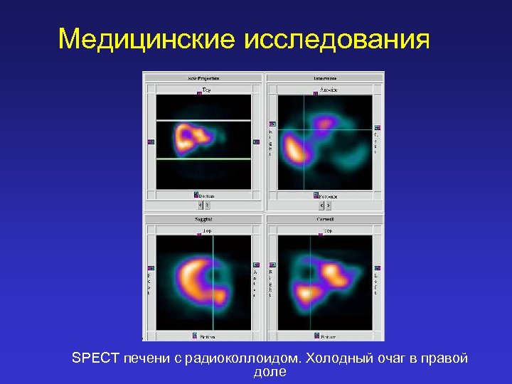 Медицинские исследования SPECT печени с радиоколлоидом. Холодный очаг в правой доле 