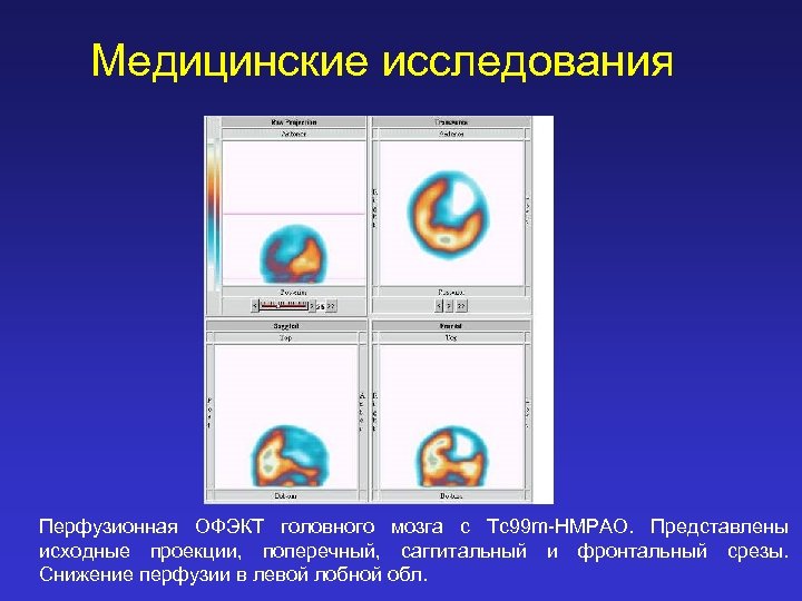 Медицинские исследования Перфузионная ОФЭКТ головного мозга с Tc 99 m-HMPAO. Представлены исходные проекции, поперечный,