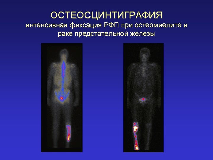 ОСТЕОСЦИНТИГРАФИЯ интенсивная фиксация РФП при остеомиелите и раке предстательной железы 