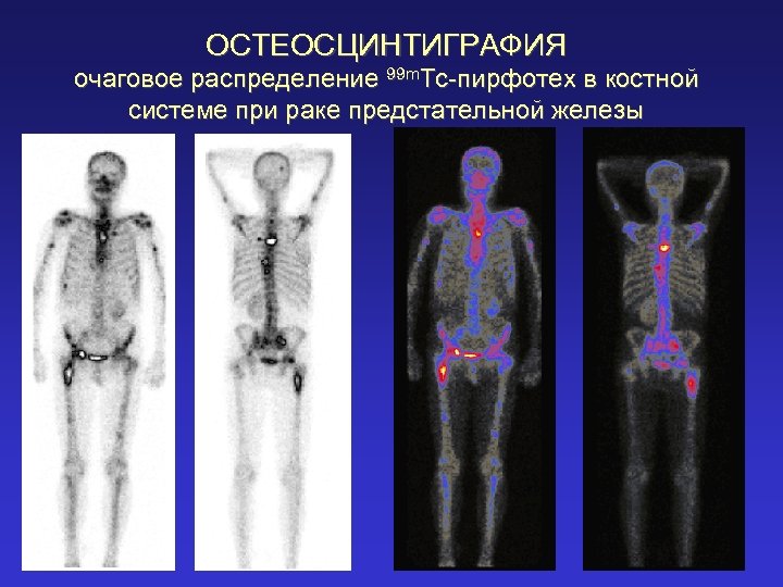 ОСТЕОСЦИНТИГРАФИЯ очаговое распределение 99 m. Tc-пирфотех в костной системе при раке предстательной железы 