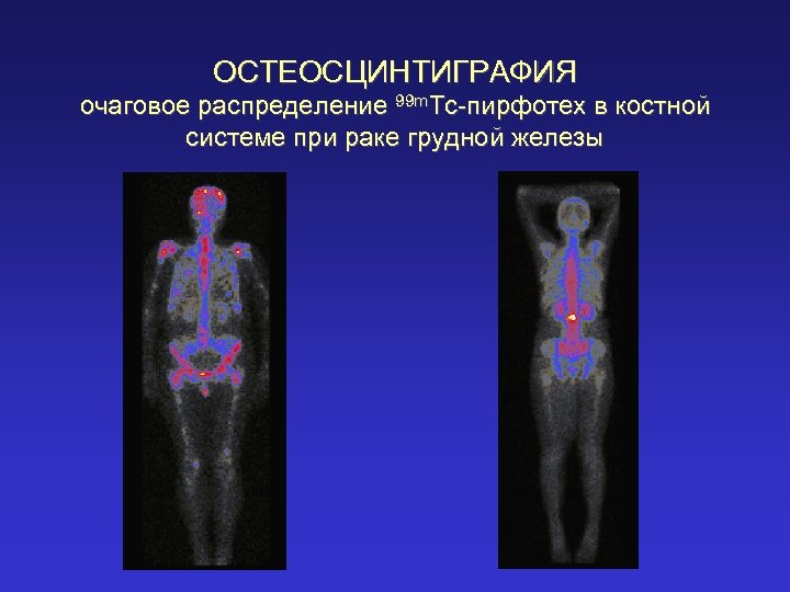 ОСТЕОСЦИНТИГРАФИЯ очаговое распределение 99 m. Tc-пирфотех в костной системе при раке грудной железы 