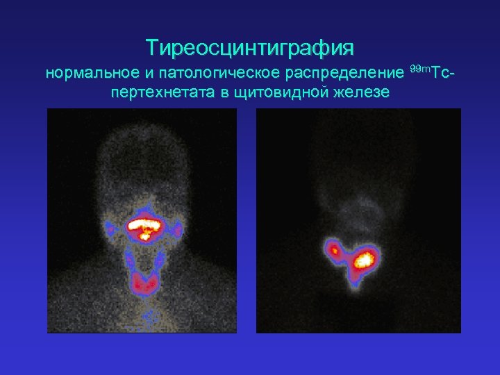 Тиреосцинтиграфия нормальное и патологическое распределение 99 m. Tcпертехнетата в щитовидной железе 