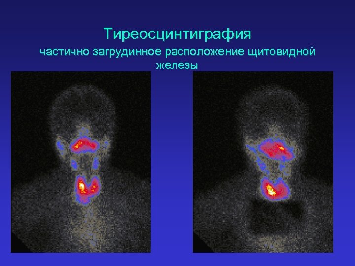 Тиреосцинтиграфия частично загрудинное расположение щитовидной железы 