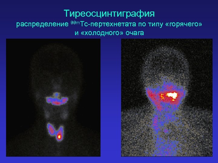 Тиреосцинтиграфия распределение 99 m. Tc-пертехнетата по типу «горячего» и «холодного» очага 