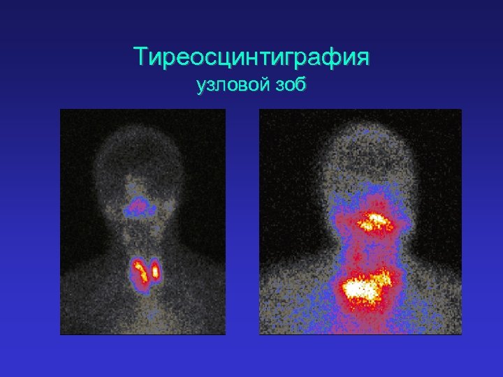 Узловой зоб картинки