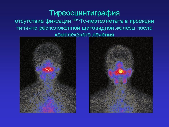 Тиреосцинтиграфия отсутствие фиксации 99 m. Tc-пертехнетата в проекции типично расположенной щитовидной железы после комплексного