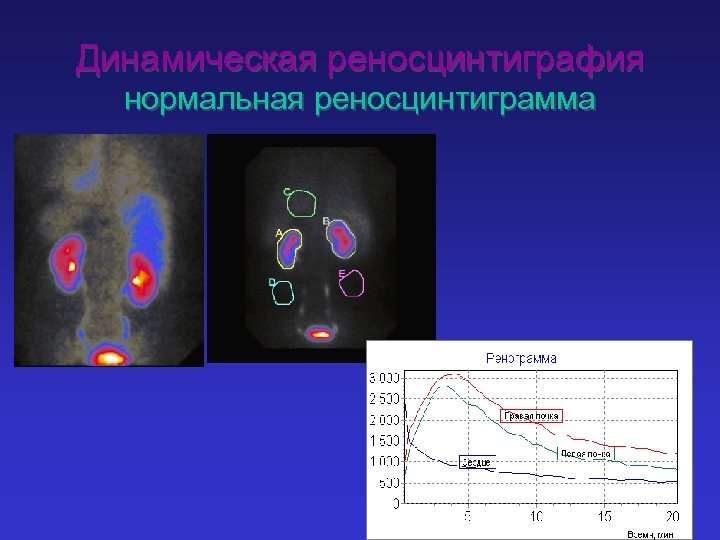 Динамическая реносцинтиграфия нормальная реносцинтиграмма 