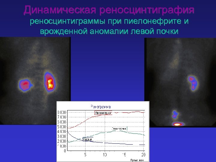 Динамическая реносцинтиграфия реноcцинтиграммы при пиелонефрите и врожденной аномалии левой почки 