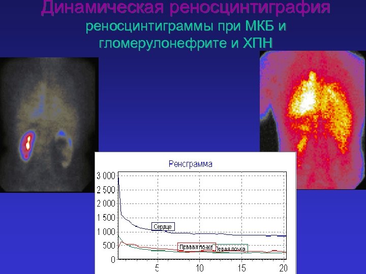 Динамическая реносцинтиграфия реносцинтиграммы при МКБ и гломерулонефрите и ХПН 