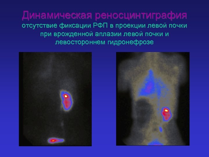 Динамическая реносцинтиграфия отсутствие фиксации РФП в проекции левой почки при врожденной аплазии левой почки