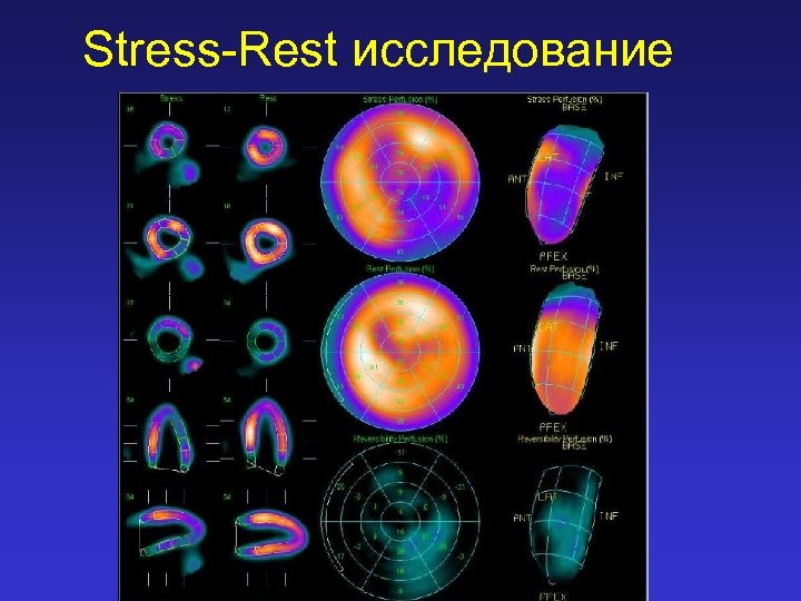 Stress-Rest исследование 