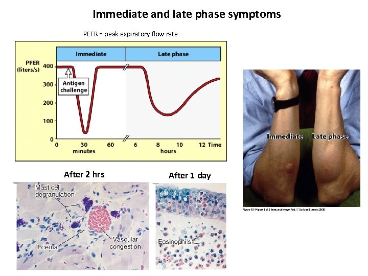 Immediate and late phase symptoms PEFR = peak expiratory flow rate After 2 hrs