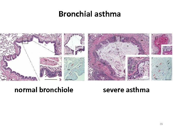 Bronchial asthma normal bronchiole severe asthma 29 