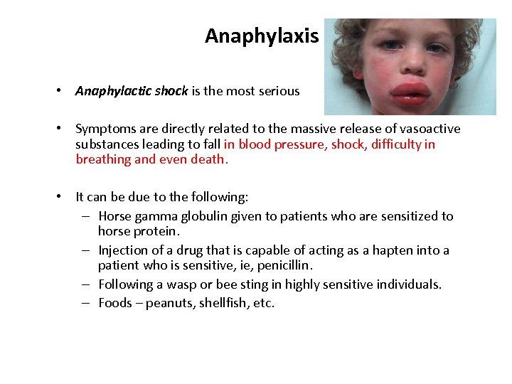 Anaphylaxis • Anaphylactic shock is the most serious • Symptoms are directly related to