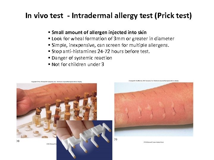 In vivo test - Intradermal allergy test (Prick test) § Small amount of allergen
