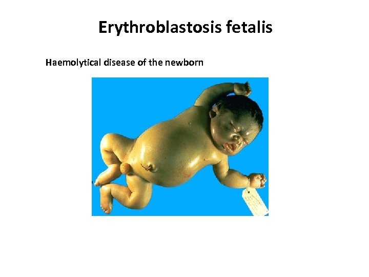 Erythroblastosis fetalis Haemolytical disease of the newborn 