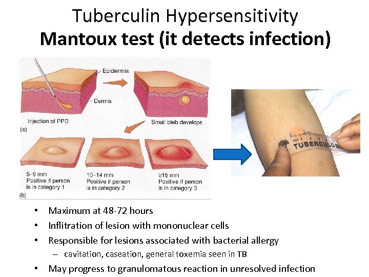 Tuberculin Hypersensitivity Mantoux test (it detects infection) • Maximum at 48 -72 hours •