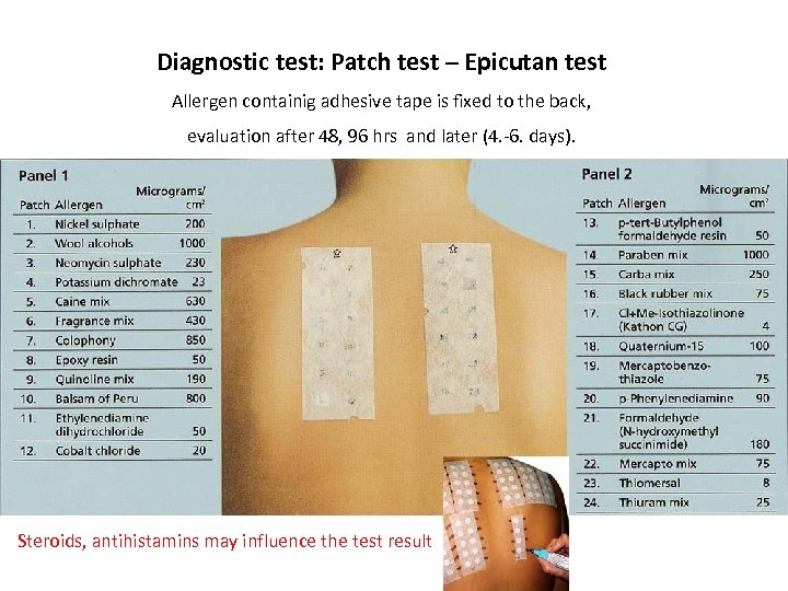 Diagnostic test: Patch test – Epicutan test Allergen containig adhesive tape is fixed to