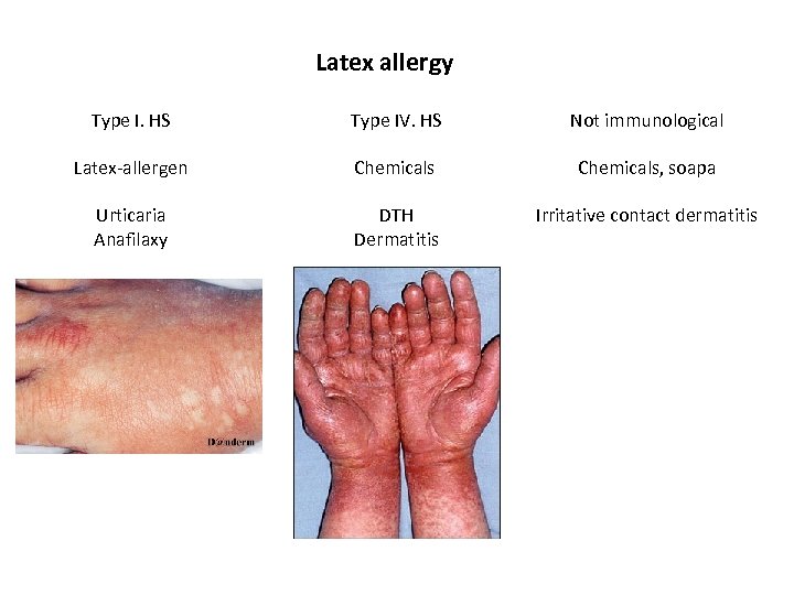 Latex allergy Type I. HS Type IV. HS Not immunological Latex-allergen Chemicals, soapa Urticaria