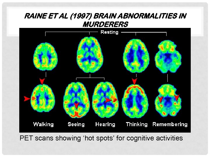 RAINE ET AL (1997) BRAIN ABNORMALITIES IN MURDERERS PET scans showing ‘hot spots’ for