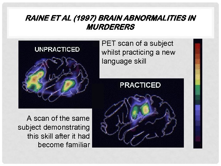 RAINE ET AL (1997) BRAIN ABNORMALITIES IN MURDERERS PET scan of a subject whilst