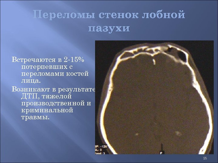 Перелом задней стенки лобной пазухи